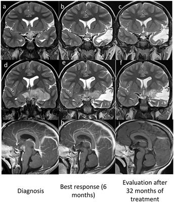 Vemurafenib Treatment of Pleomorphic Xanthoastrocytoma in a Child With Down Syndrome